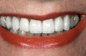 Cosmetic Dentistry After Photo - Dr. Jay W. Dorgan DDS