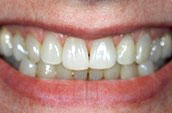 Cosmetic Dentistry in Kennett Square, PA Before Photo