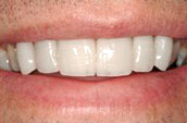 Dental Makeovers After Photo - Kennett Square Pennsylvania