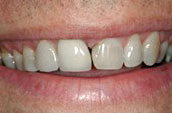 Dental Makeovers - Before Photo - Kennett Square Pennsylvania