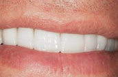 Dental Makeovers and Veneers - Dr. Jay W. Dorgan, DDS - Kennett Square