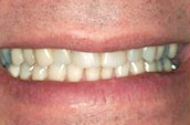 Dental Makeovers and Whitening - Dr. Jay W. Dorgan, DDS - Kennett Square