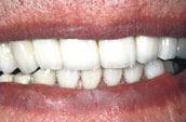 Dental Veneers After Photo