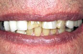 Dental Veneers Before Photo