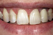 Dentist Kennett Square PA - Before Photo