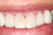 Dental Whitening After Photo - Kennett Square, PA