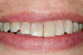 Whitening Before Photo - Dentist - Kennett Sqare, PA