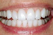 Dentists in Kennett Square - After Photo