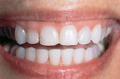 Dentists in Kennett Square - Before Photo