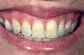 Smile Makeover at Jay W. Dorgan Dentistry