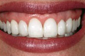 Teeth Whitening After Photo - Dr. Jay W. Dorgan DDS