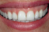 Teeth Whitening Before Photo - Jay W. Dorgan DDS