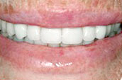 Tooth Cleaning After Photo - Dr. Jay W. Dorgan, DDS