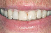 Tooth Cleaning Before Photo - Dr. Jay W. Dorgan, DDS