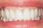 Teeth Straightening - Kennett Square, PA - After Photo