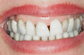 Teeth Straightening - Kennett Square, PA - Before Photo